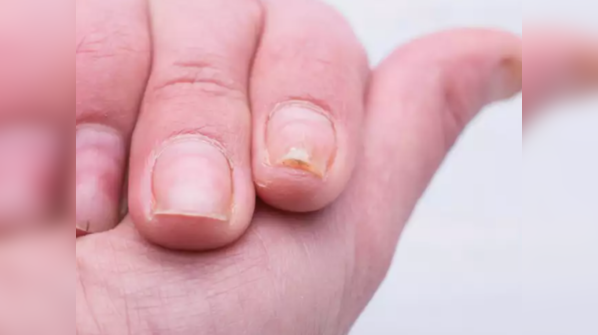 Ripples in nails