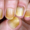 ​Yellow nails