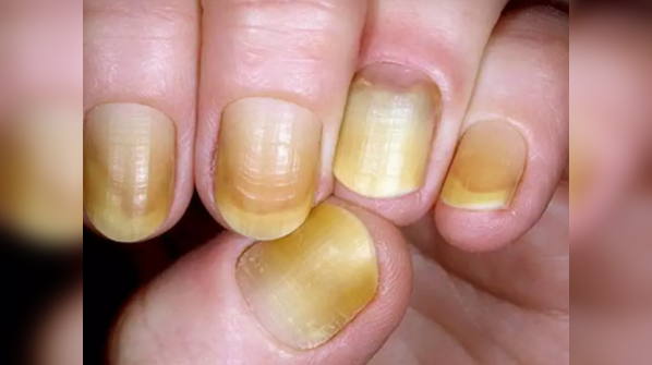Yellow nails