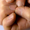 ​Brittle nails