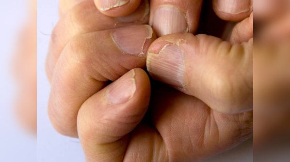 Brittle nails