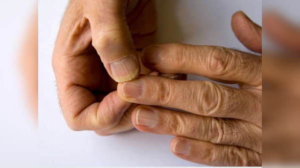 What the texture and colour of your nails can tell you about your health