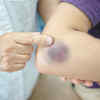 ​Easily bleeding or bruising
