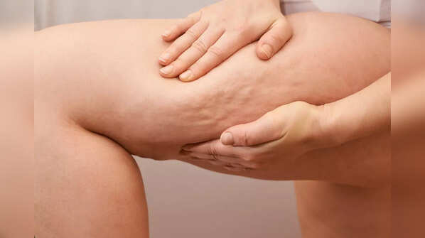 Cellulite reduction