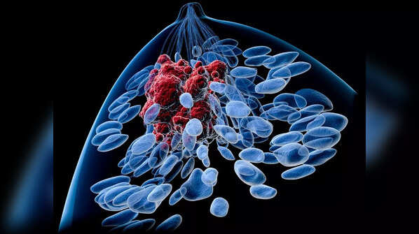 BRCA1, BRCA2 gene: The breast cancer gene