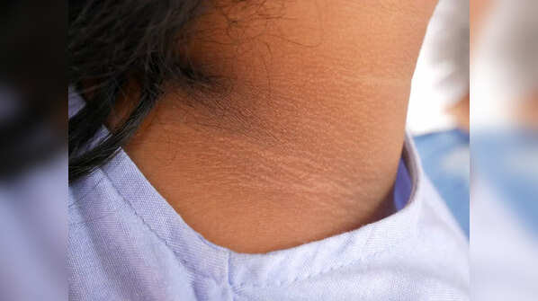 Darkening of skin folds around the neck