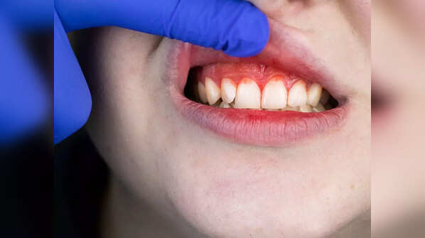 Bleeding gums