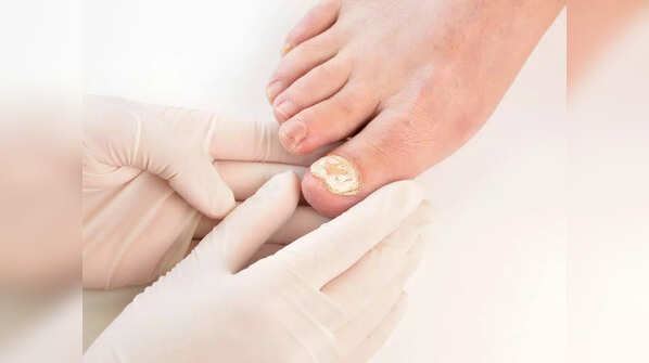 Fungal nail infection