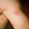 Ringworm