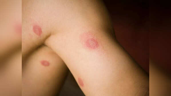 Ringworm