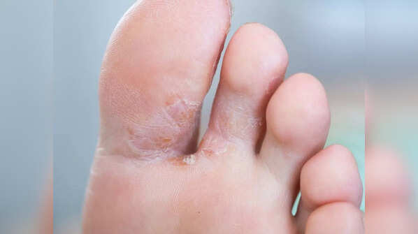 Athlete's foot