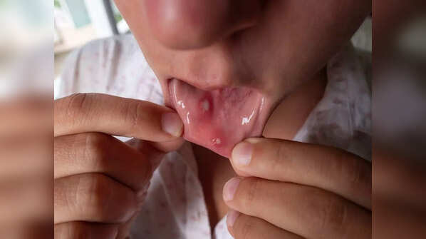 Yeast infection