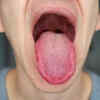 Changes in the texture of the tongue