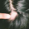 Alopecia areata