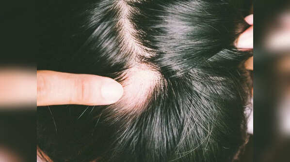 Alopecia areata