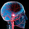 A person with high blood pressure may be more prone to a stroke