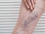 Swollen veins, hard and painful to touch