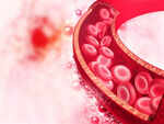 What is Deep Vein Thrombosis (DVT)?