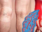 Beware of these signs of blood clot in your legs