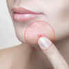 Skin acne and dryness