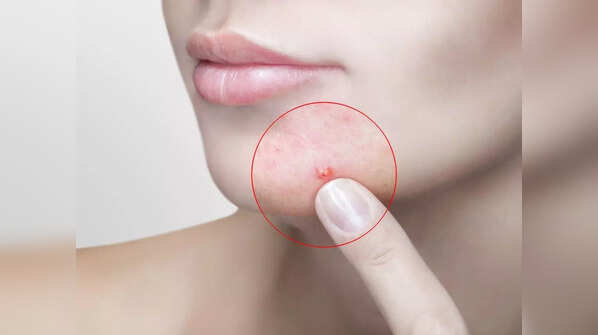 Skin acne and dryness