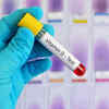 The sure-shot way to detect low Vitamin D levels in the body