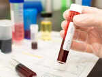 Can HIV be cured without drug use and transplants?