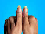 ​Pale or yellow nails