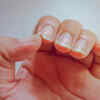 ​Brittle nail