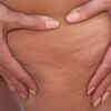 Subcutaneous fat