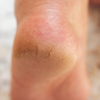 Treat cracked heels