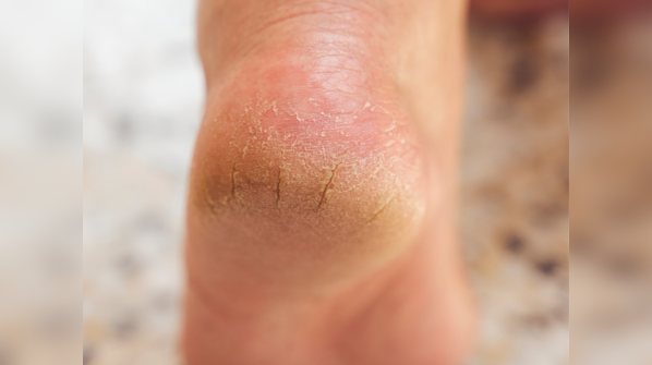 Treat cracked heels