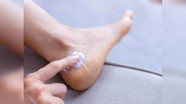Cracked heels are a sign of vitamin deficiency