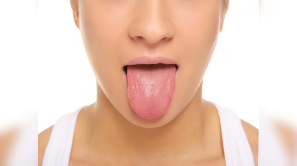 Of the many peculiar COVID infection symptoms, one is COVID tongue.