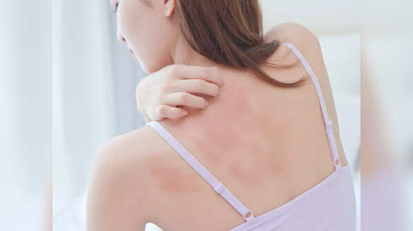 Itchy skin