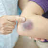 Frequent bleeding and bruising