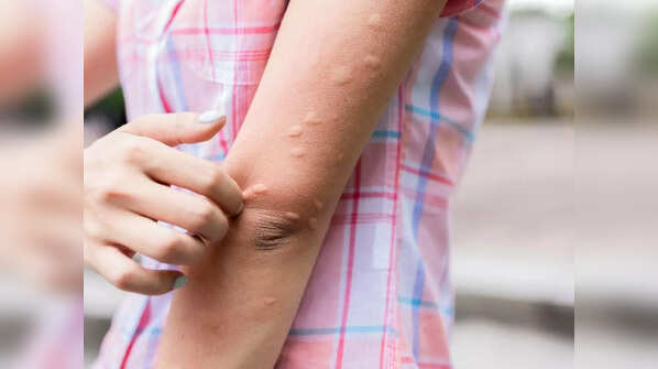 Other types of rashes that could signal COVID-19 infection