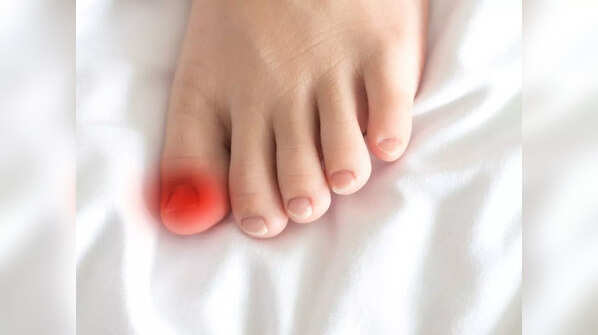 COVID digits: Coronavirus-induced skin condition