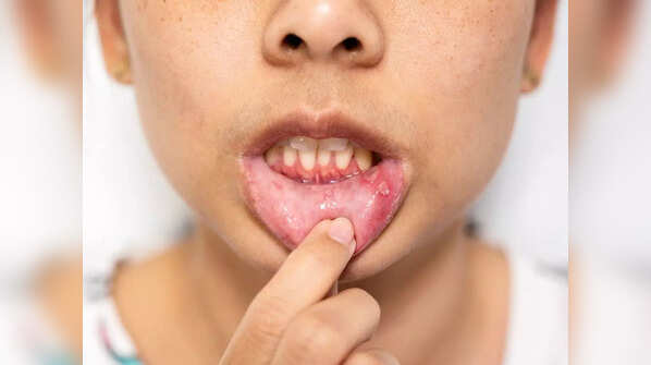 Mouth Sores