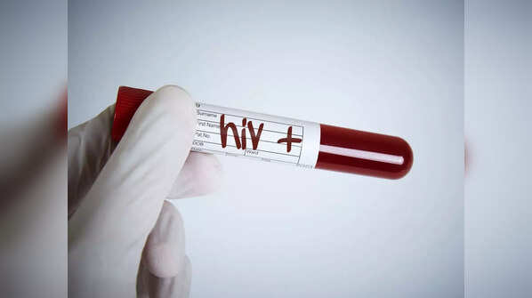 HIV infection