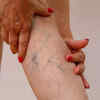 Signs of deep vein thrombosis (DVT)