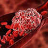 Blood clot in the leg could be a sign of pancreatic cancer