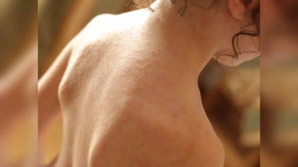 What causes monkeypox vs. COVID-19?