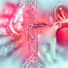 The link between high cholesterol and peripheral artery disease (PAD)