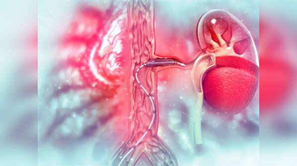 The link between high cholesterol and peripheral artery disease (PAD)