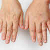 What is the cause of Prince Charles' swollen finger?