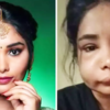 Article image for: Pictures of Kannada actress Swathi Sathish go viral after her <i class="tbold">root canal</i> surgery goes wrong