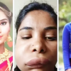 Article image for: Pictures of Kannada actress Swathi Sathish go viral after her <i class="tbold">root canal</i> surgery goes wrong
