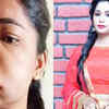 Article image for: Pictures of Kannada actress Swathi Sathish go viral after her <i class="tbold">root canal</i> surgery goes wrong