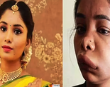 Pictures of Kannada actress Swathi Sathish go viral after her root canal surgery goes wrong